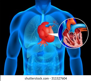 Human heart with cancer illustration