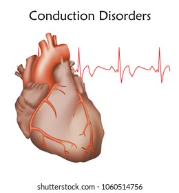 Human Heart. Conduction Disorders. Anatomy Illustration. Red Image, White Background. Heartbeat, Pulse.