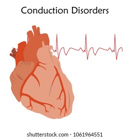 Human Heart. Conduction Disorders. Anatomy Flat Illustration. Red Image, White Background. Heartbeat, Pulse.