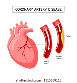 Human Heart With Coronary Artery Disease Infographic. Blocked Artery, Heart Awareness Concept. Illustration Isolated On White Background.