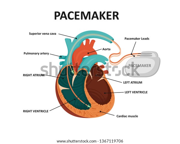 Кардиостимулятор сердца картинки