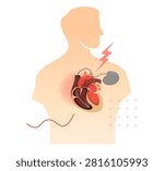 Human Heart with Pacemaker - Restoring Normal Rhythm - Stock Illustration as EPS 10 File
