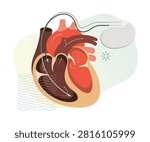 Human Heart with Pacemaker - Restoring Normal Rhythm - Stock Illustration as EPS 10 File