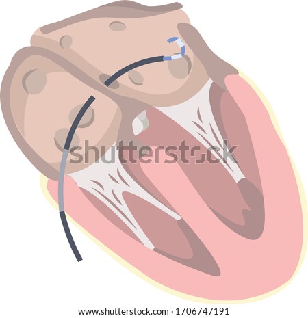 Human heart showing left atrium mapping and ablation