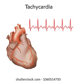 Human heart. Tachycardia. Anatomy illustration. Red image, white background. Heartbeat, pulse.