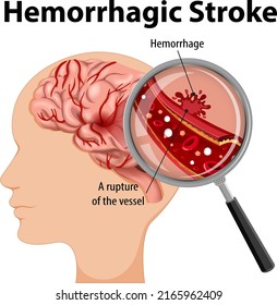 Human with Hemorrhagic stroke illustration