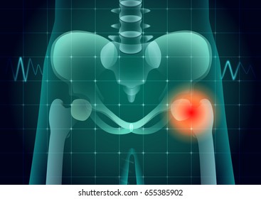 Human hip bone pain medical scan concept. Illustration about diagnose of body injury with Physical science.