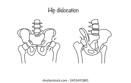 Human hip dislocation. Violation of the position of the femur in the hip joint. Line drawn medical illustration.