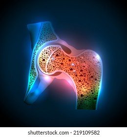 Human Hip Joint And Osteoporosis On A Abstract Blue Background