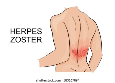 Human Infection Herpes Zoster