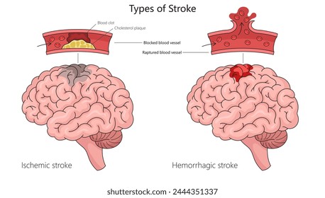 Accidente cerebrovascular isquémico humano y accidente cerebrovascular hemorrágico en la anatomía cerebral humana diagrama de estructura dibujado a mano Ilustración vectorial esquemática. Ilustración educativa de ciencias médicas