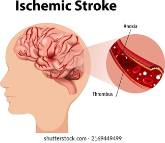 Human with Ischemic stroke illustration