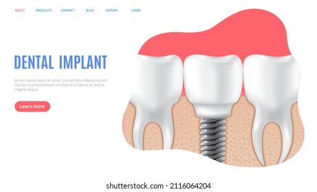 Human jaw with normal teeth and prosthesis above dental implant structure. Tooth after dental procedure. Surgical implant in oral cavity. Treatment, dentistry, oral care. Healthy tooth in human gum