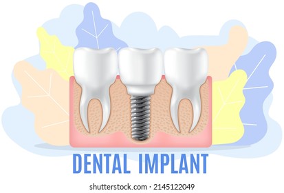 Human jaw with normal teeth and prosthesis above dental implant structure. Tooth after dental procedure. Surgical implant in oral cavity. Treatment, dentistry, oral care. Healthy tooth in human gum