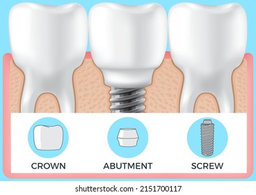 Human jaw with normal teeth and prosthesis above dental implant structure. Tooth after dental procedure. Surgical implant in oral cavity. Treatment, dentistry, oral care. Healthy tooth in human gum