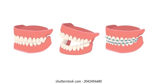 Human Jaw set isolated on white background. Opened, closed jaws and jaws with braces. Dental model of human jaws. Healthy oral hygiene. Trendy graphic for stomatology, dentist. Vector illustration