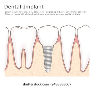 Human jaw with teeth and dental implant. Vector illustration. 