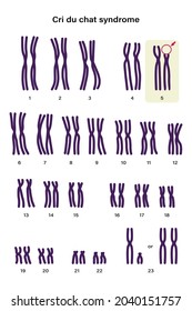 Human karyotype of Cri du chat syndrome. Autosomal abnormalities. A piece of chromosome 5 is missing