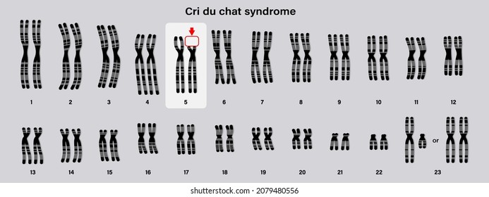 Human karyotype of Cri du chat syndrome. Autosomal abnormalities. A piece of chromosome 5 is missing.