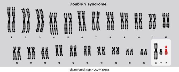 Human karyotype of Double y syndrome. XYY. Male has an extra Y chromosome.