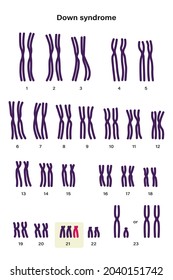 Human karyotype of Down syndrome. Autosomal abnormalities. Down syndrome have an extra copy of one of these chromosomes, chromosome 21. Trisomy 21. Genetic disorder 