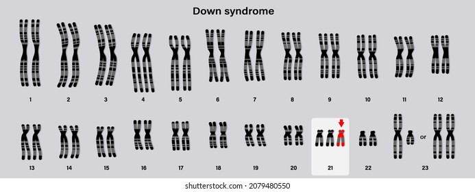 Human karyotype of Down syndrome. Autosomal abnormalities. Trisomy 21. Genetic disorder. 