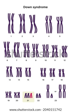 Human karyotype of Down syndrome. Autosomal abnormalities. Down syndrome have an extra copy of one of these chromosomes, chromosome 21. Trisomy 21. Genetic disorder 