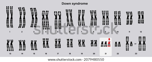 Human Karyotype Down Syndrome Autosomal Abnormalities Stock Vector Royalty Free 2079480550 8229