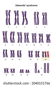 Human karyotype of Edwards' syndrome. Autosomal abnormalities. Edwards' syndrome have an extra copy of one of these chromosomes, chromosome 18. Trisomy 18, Genetic disorder 