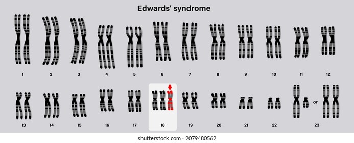 Human karyotype of Edwards' syndrome. Autosomal abnormalities. Trisomy 18. Genetic disorder. 