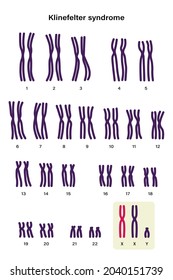 Human karyotype of Klinefelter syndrome. Klinefelter's, KS or XXY.