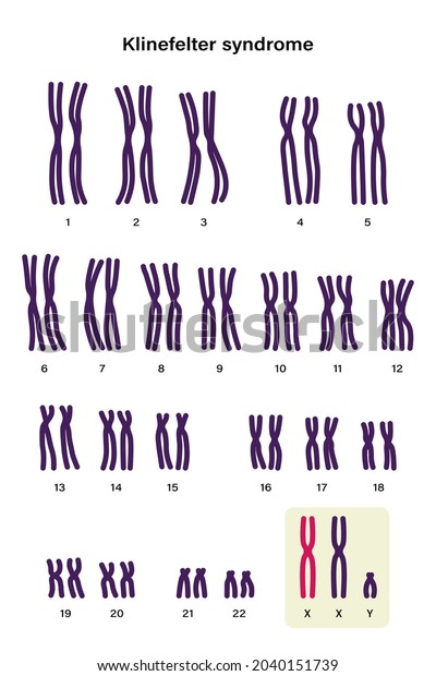 Human Karyotype Klinefelter Syndrome Klinefelters Ks Stock Vector ...
