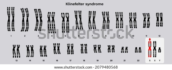 Human Karyotype Klinefelter Syndrome Klinefelters Ks Stock Vector