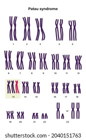 Human karyotype of Patau syndrome. Autosomal abnormalities. Patau syndrome have an extra copy of one of these chromosomes, chromosome 13. Trisomy 13, Genetic disorder 