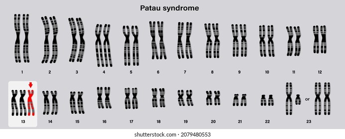 Human karyotype of Patau syndrome. Autosomal abnormalities. Trisomy 13. Genetic disorder. 