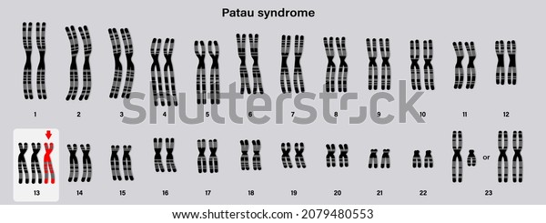 Human Karyotype Patau Syndrome Autosomal Abnormalities Stock Vector ...