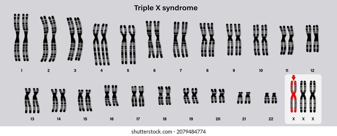 Human karyotype of Triple x syndrome. Female has an extra X chromosome.