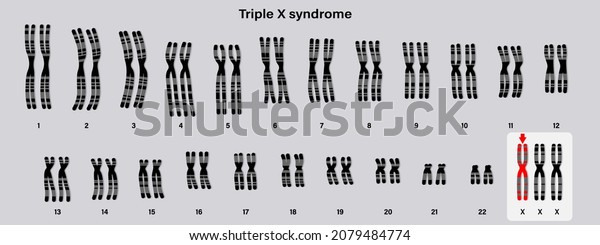 Human Karyotype Triple X Syndrome Female human-karyotype-triple-x-syndrome-female
