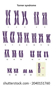 Human karyotype of Turner syndrome. One of the X chromosomes (sex chromosomes) is missing or partially missing. 45,X, or 45,X0