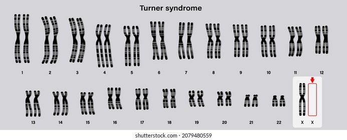 Human karyotype of Turner syndrome. One of the X chromosomes (sex chromosomes) is missing or partially missing. 45,X, or 45,X0.