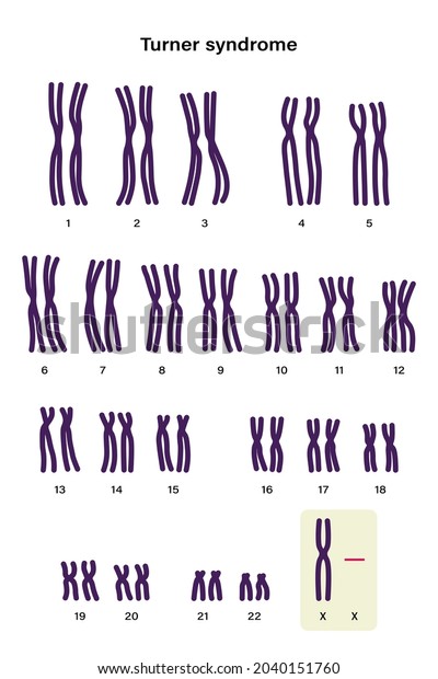 Human Karyotype Turner Syndrome One X Stock Vector Royalty Free