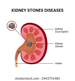 human kidney stone disease infographic