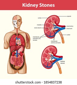 Human kidney stones anatomy cartoon style infographic illustration