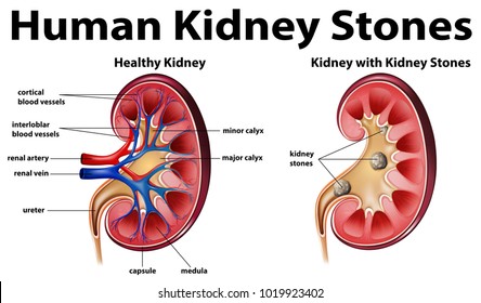 Human kidney stones anatomy medical