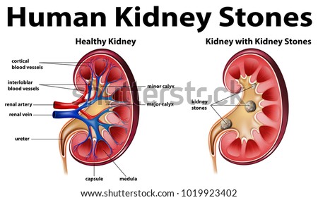 Human Kidney Stones Anatomy Medical Stock Vector (Royalty Free