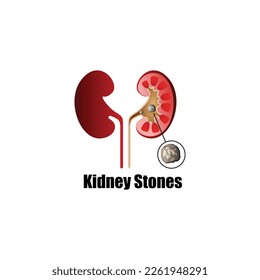 Human Kidney Stones  Kidney Inside  Kidney System  Bean shape  Vector illustration.