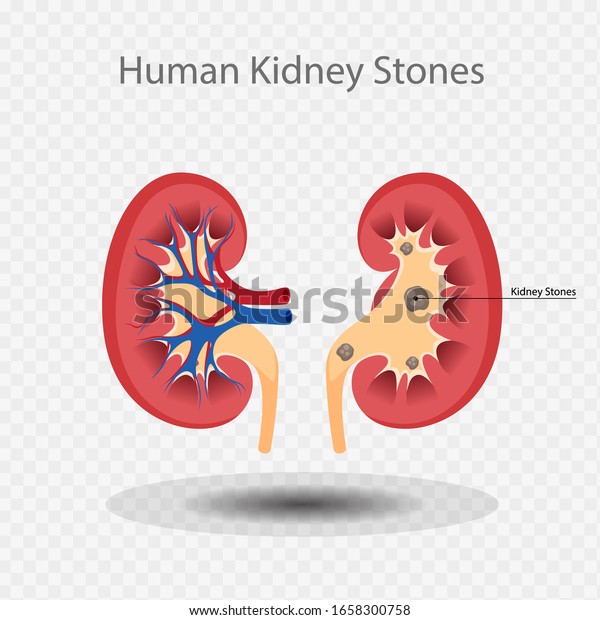 Human Kidney Stones, Kidney Inside, Kidney\
System, Bean shape, Vector\
illustration.