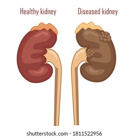 Human kidneys, excretory system. Sick and healthy kidneys, vector illustration