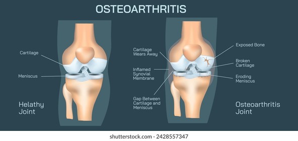 The human knee anatomy vector illustration. Common knee problems, Symptoms and causes of rheumatoid arthritis and osteoarthritis. Types of knee joint Injuries and Disorders. General condition and pain