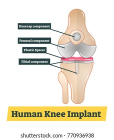 Human Knee Implant vector diagram illustration